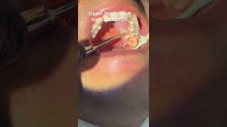 Upper third molar teeth extraction [upl. by Einnaffit]