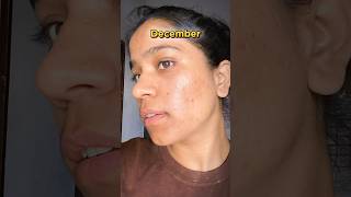 Tretinoin cream before and after  January to December Transformation  tretinoin acne face  🤫 [upl. by Riker161]