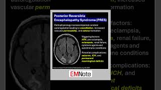 Posterior Reversible Encephalopathy Syndrome PRES doctor medical nursing [upl. by Aronle]