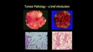 Tumour pathology  a brief introduction part III [upl. by Nielsen]