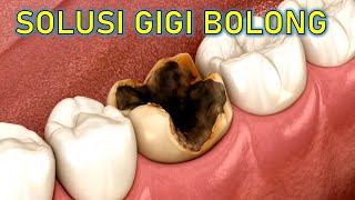 Bukan DICABUT bukan DITAMBAL‼️ Ini solusi GIGI BERLUBANG‼️ [upl. by Halstead437]