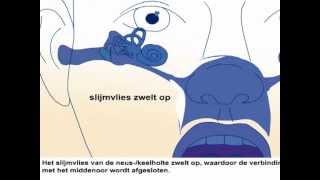 Oorontsteking  Oorzaak en behandeling oorpijn [upl. by Ahsilra]