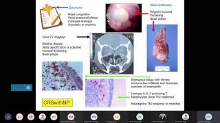 Chronic Rhinosinusitis Hamilos [upl. by Bunker235]