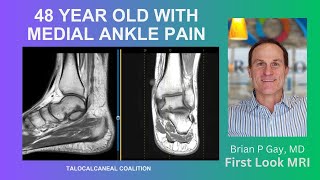 48 year old with medial ankle pain [upl. by Aitan]