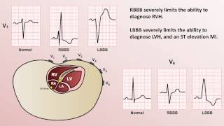 Intro to EKG Interpretation  Bundle Branch Blocks [upl. by Thedrick]