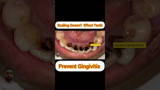 Scaling should be done To Remove Tartarcalclus [upl. by Berlin461]