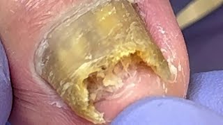 Extremely curly and growing nails infected by onychomycosis bacteria【Doctor Liu Pedicure】 [upl. by Unders588]