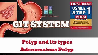 USMLE Step1 Polyp and its types Adenomatous Polyps from first aid step 1USMLEUrduHindi [upl. by Yecnuahc402]