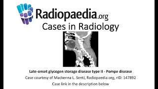 Lateonset glycogen storage disease type II  Pompe disease Radiopaediaorg Cases in Radiology [upl. by Macilroy832]