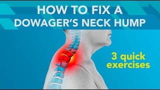 3 Easy Exercises to Fix a Dowagers Hump Buffalo Hump or Neck Hump [upl. by Aiotal63]