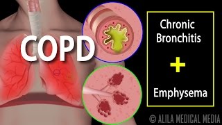 COPD  Chronic Obstructive Pulmonary Disease Animation [upl. by Aramoix]