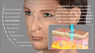 Laser vasculaire Couperose érythrose angiomes Dermatologue à Pau Tarbes [upl. by Narat252]