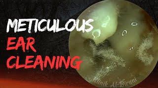 Meticulous Ear Cleaning Save This Eardrum ‼️ [upl. by Treboh]