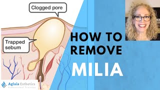 HOW TO REMOVE A MILIA STEP BY STEP  NATURALLY [upl. by Okorih]