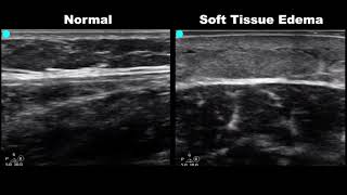 POCUS  Soft Tissue Ultrasound  Subcutaneous Air [upl. by Ise]