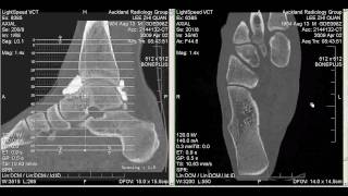 CT Arthrogram of my Ankle 2 April 2009 [upl. by Aihcropal799]