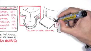 Introduction to Direct and Indirect Inguinal Hernia [upl. by Jaime267]