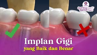 INILAH IMPLANT GIGI YANG BENAR DAN SEHAT [upl. by Helali]