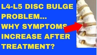 Why Does L4 L5 Disc Bulge Symptom Increase After Treatment  Answered by Chiropractor in Vaughan [upl. by Ytirahs]