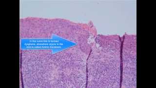 Squamous Cell Carcinoma [upl. by Ivo]