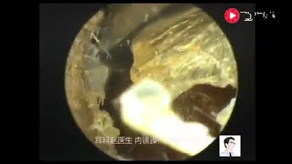 Seven cases of dry external ear canal [upl. by Ait]