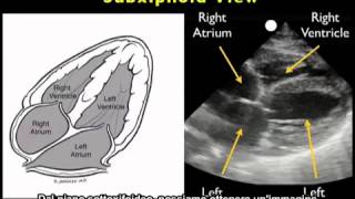 Video procedurale Ecocardiografia cardiaca  Vista sottocostale [upl. by Eizzil]