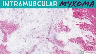 Intramuscular Myxoma 5Minute Pathology Pearls [upl. by Meuser]