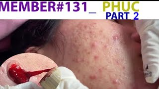 Acne Treatment Huong Da Nang 131 MEMBER Phuc Part 2 [upl. by Qulllon]