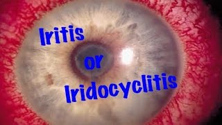 Medical Video Lecture Ophthalmology Iridocyclitis or Iritis Made simple [upl. by Esilana622]