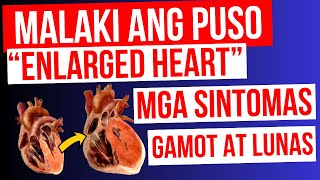 ENLARGED HEART  Lumalaki ang PUSO  Mga Sintomas Gamot at LUNAS  Cardiomegaly Heart Failure [upl. by Leandro139]