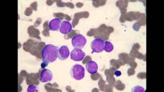 Acute Myeloblastic Leukemia M1 [upl. by Norahc]