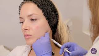 Radiesse Dermal Filler  Jawline Face Contouring [upl. by Trudey]