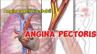 Angina pectoris [upl. by Helene647]