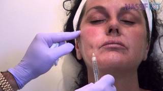 How To Use Blunt Cannula for Facial Fillers  Dr Paul Nassif [upl. by Kenwee]