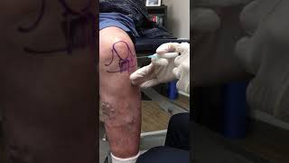 Anterior Knee Injection  Elite Sports Medicine  Lethbridge [upl. by Tortosa]