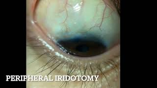 Peripheral Iridotomy [upl. by Henrietta]