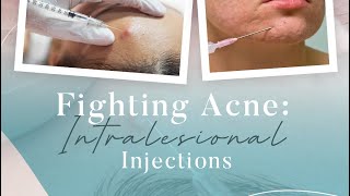 Fighting Acne Intralesional Injections [upl. by Hy]