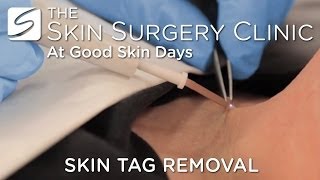 Skin Tag Removal  Watch the Procedure [upl. by Eilloh]