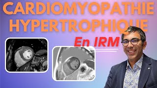 Cardiomyopathie Hypertrophique CMH en IRM  lessentiel en 11 minutes [upl. by Nowad]