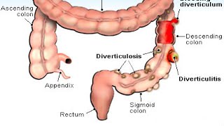 Diverticulitis [upl. by Ellehsat435]