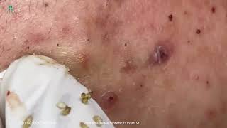 Big Cystic Acne Blackheads Extraction Blackheads amp Milia Whiteheads Removal Pimple Popping [upl. by Cherilynn]