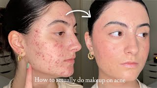 How to Make Makeup Look Smooth amp Natural on Acne and Textured Skin [upl. by Malory]