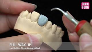 Full wax up Upper Central Incisor [upl. by Egidio]