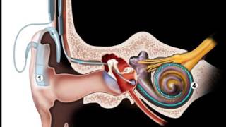 Implant cochléaire S Blatrix [upl. by Nanda934]