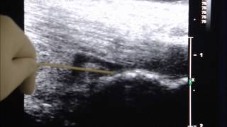 UltrasoundGuided Injection Treatment of Retrocalacaneal Bursitis [upl. by Reffineg]