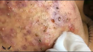 Blackhead Whitehead Removal  Cystic Acne Treatment  Elderly Pimple Popping  Facial Acne Spa 082 [upl. by Avek]