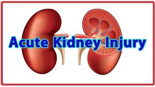 IRAAcute Kidney Injury [upl. by Ilagam]