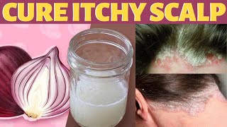 Scalp Psoriasis Treatment At Home  Natural Remedies [upl. by Maurine]