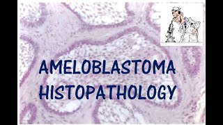 AMELOBLASTOMA HISTOPATHOLOGY I ORAL PATHOLOGY [upl. by Bencion107]