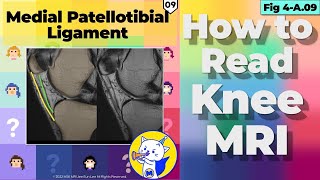 Fig 4A09 Medial Patellotibial Ligament MPTL Sagittal image [upl. by Otsedom]